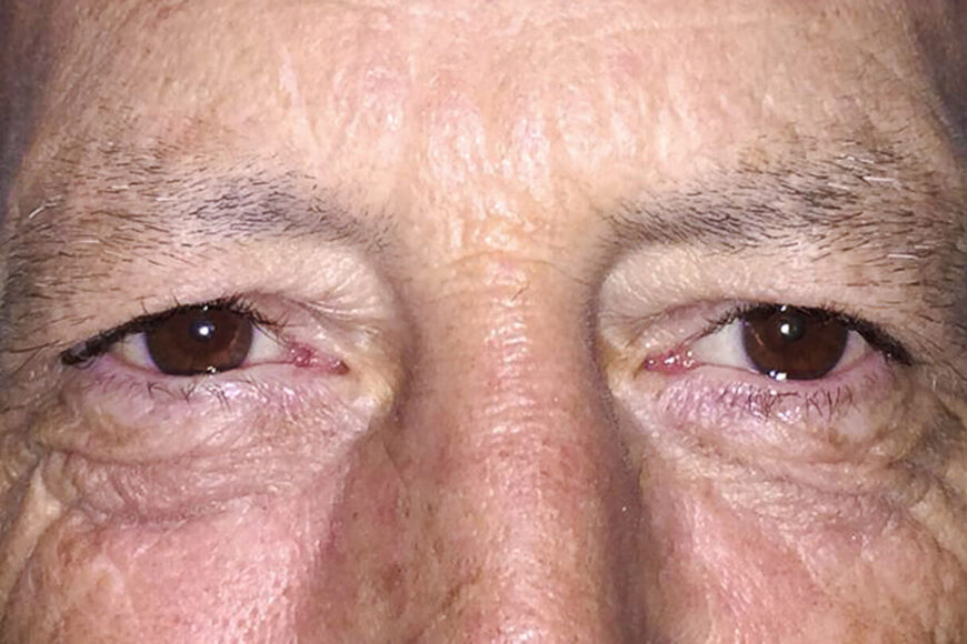 Blefaroplastia