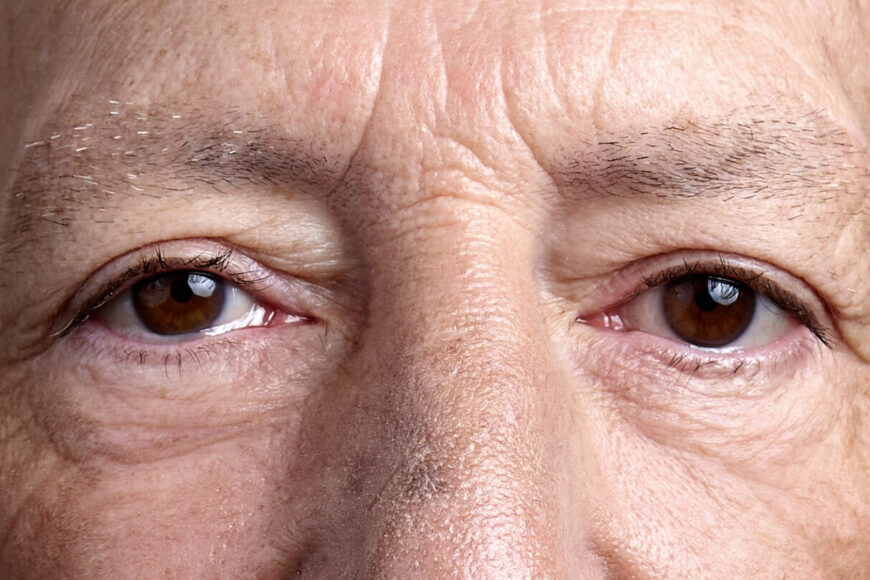 Blefaroplastia