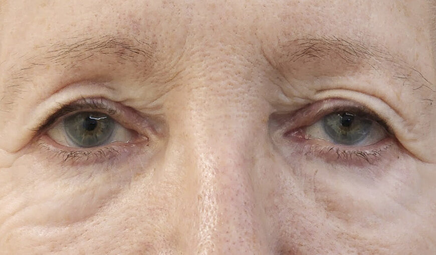 Blefaroplastia