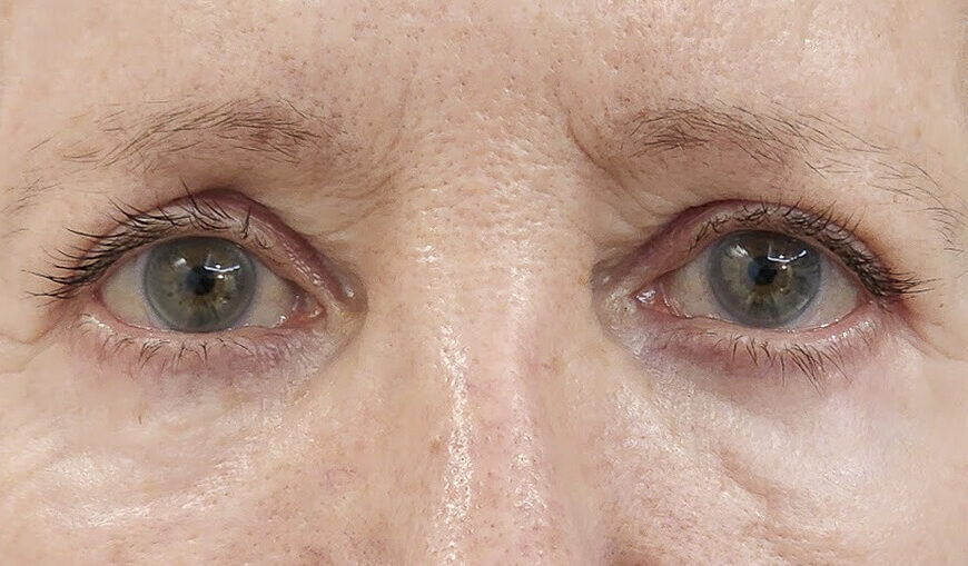 Blefaroplastia