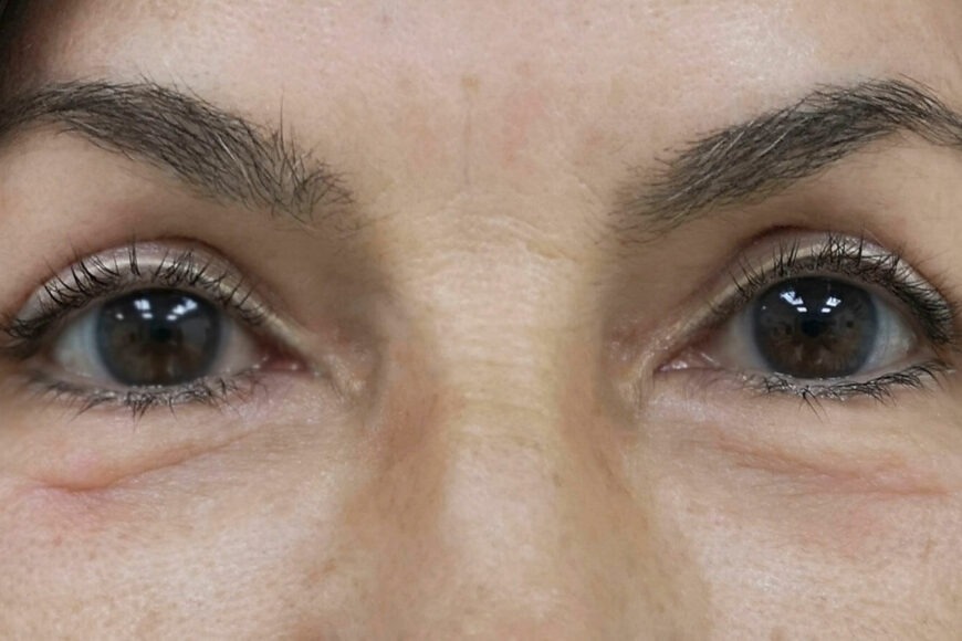 Dos meses después de la blefaroplastia