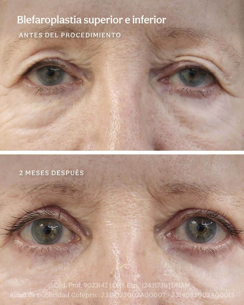 Cirugía estética de párpados