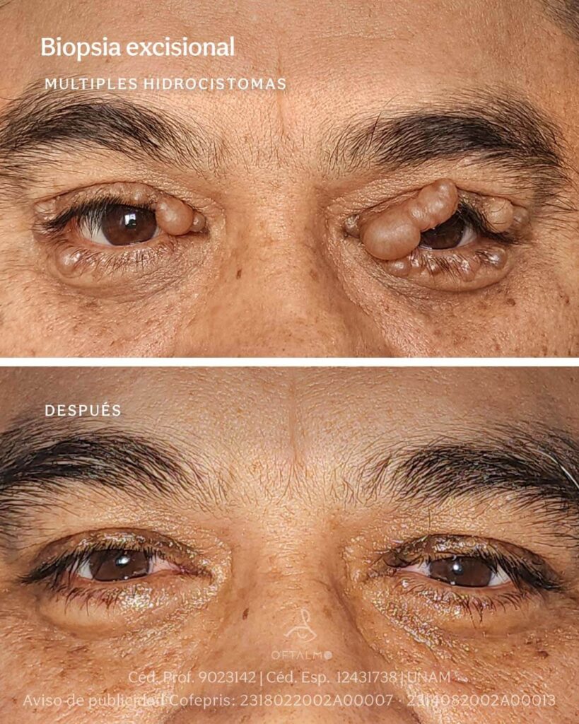 Tratamiento para tumores palpebrales