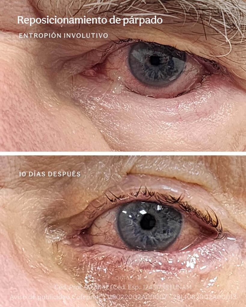 Cirugía funcional de párpados - Entropión